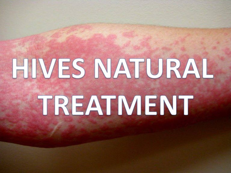 hives-natural-treatment